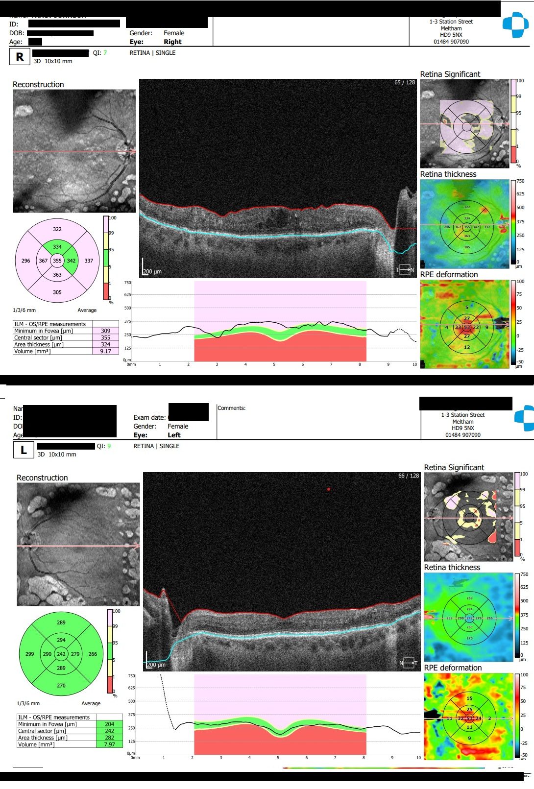 3D OCT Scan showing haems R&L extensive PRP scarring